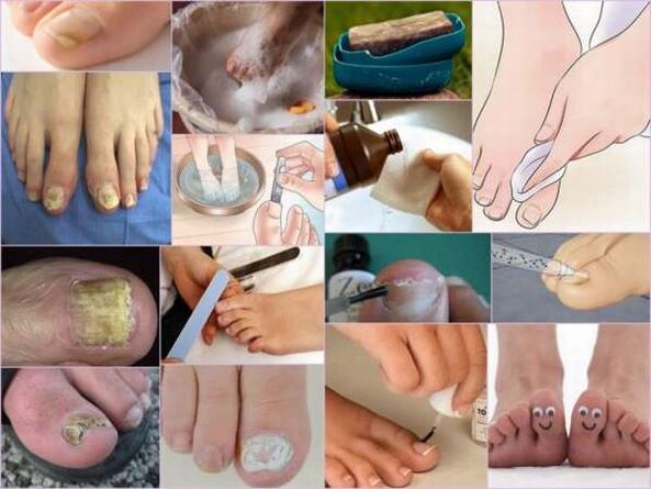 tratamentul ciupercii unghiilor de pe mână cu iod